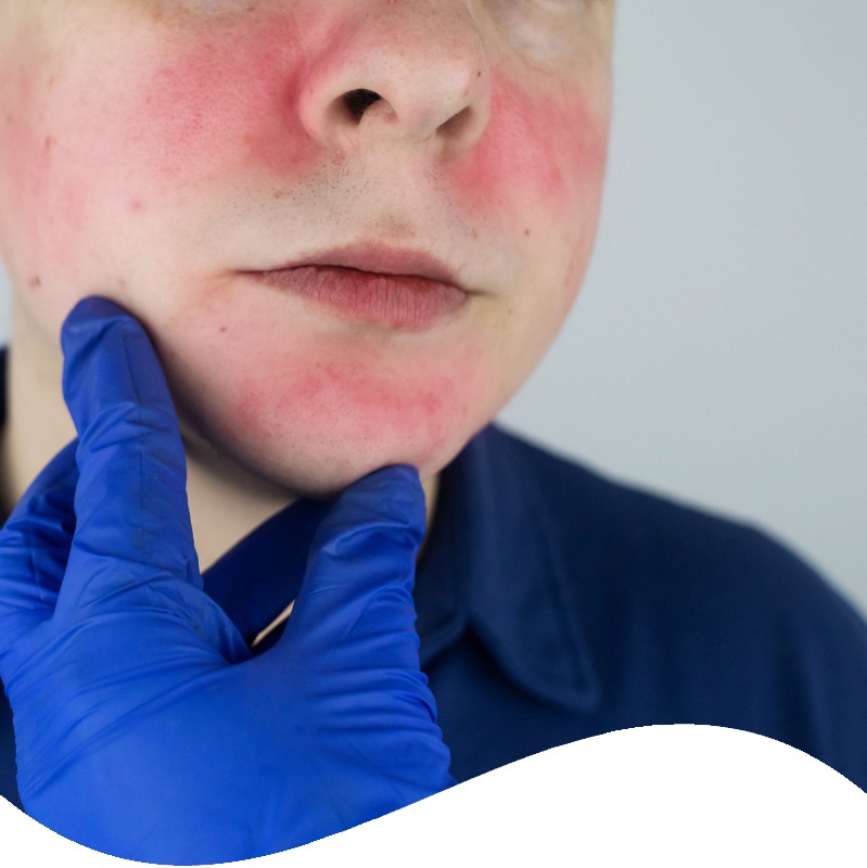 Rosacea (1)